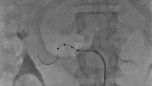 ipertensione arteriosa