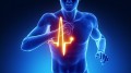 Infarto align=